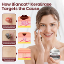 BioClear Skin - Creme removedor de Verrugas