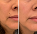 Clarivex Patch - remoção de acne e verrugas | Remove Verrugas Salientes, Acne, Verrugas Planas e Marcas de Pele | Ajuda a Melhorar Rugas, Cicatrizes e Imperfeições | Adesivos Invisíveis para Rosto e Corpo