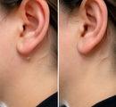 Clarivex Patch - remoção de acne e verrugas | Remove Verrugas Salientes, Acne, Verrugas Planas e Marcas de Pele | Ajuda a Melhorar Rugas, Cicatrizes e Imperfeições | Adesivos Invisíveis para Rosto e Corpo