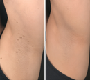 Clarivex Patch - remoção de acne e verrugas | Remove Verrugas Salientes, Acne, Verrugas Planas e Marcas de Pele | Ajuda a Melhorar Rugas, Cicatrizes e Imperfeições | Adesivos Invisíveis para Rosto e Corpo