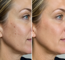 Clarivex Patch - remoção de acne e verrugas | Remove Verrugas Salientes, Acne, Verrugas Planas e Marcas de Pele | Ajuda a Melhorar Rugas, Cicatrizes e Imperfeições | Adesivos Invisíveis para Rosto e Corpo